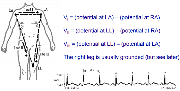 ECG%20Electrode%20placement